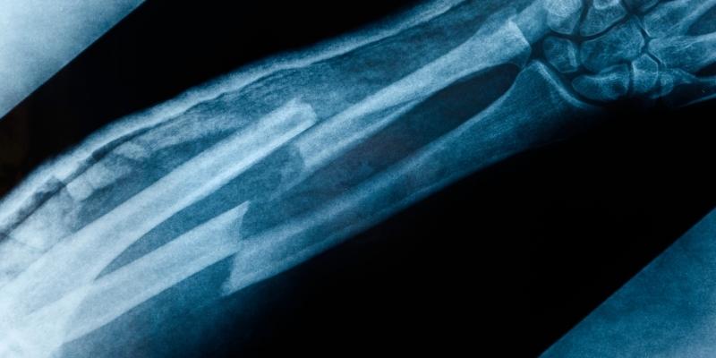 Gãy tay nhưng hồi phục nhanh chứng tỏ sự kiên cường